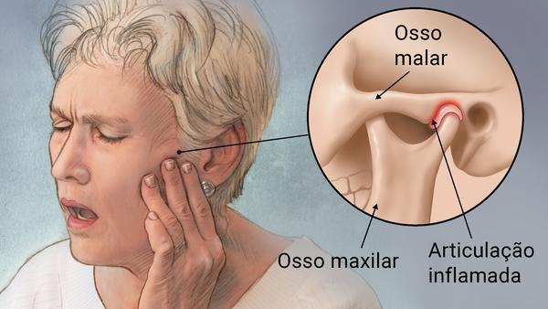 O que é Disfunção Temporomandibular? - Mega Imagem